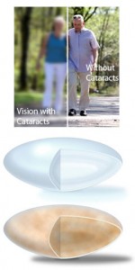 Cataract Surgery in Denver Co